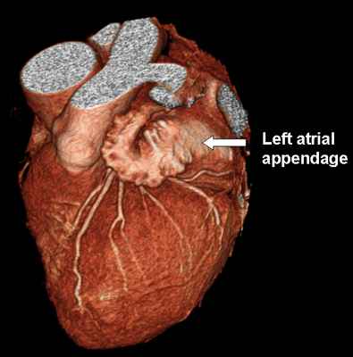 Left-atrial-appendage-Image