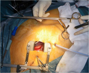 Tumores Anexiais - CEVESP - Cirurgia Minimamente Invasiva