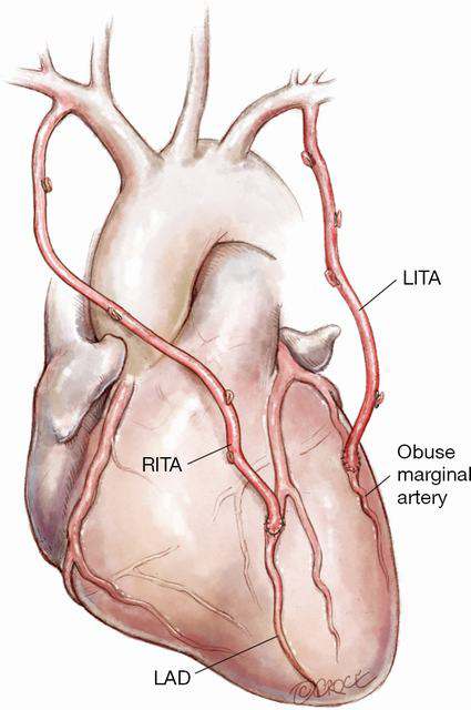 Revascularizacao Da Arteria Descendente Anterior Pela Toracica Interna Direita Futuro Padrao Ouro Brazilian Journal Of Cardiovascular Surgery Blog